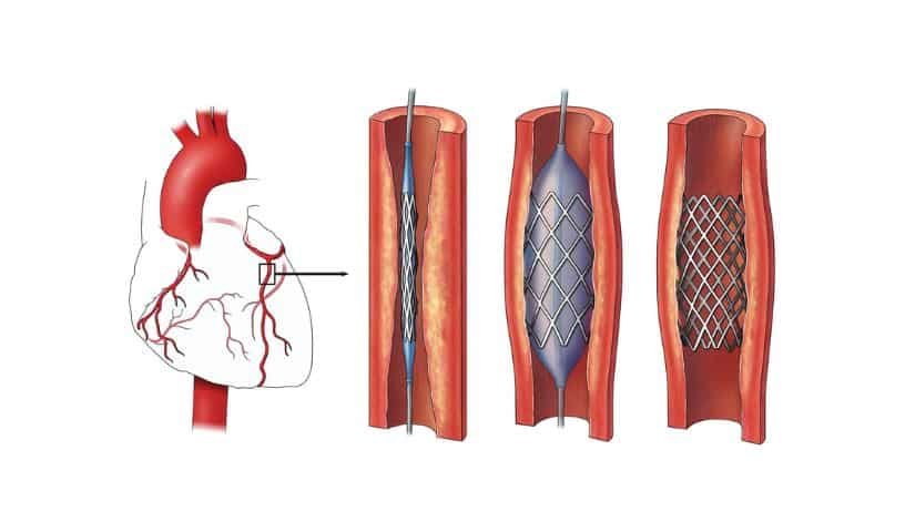 Cardiac Stents Price Capped in India Now More Affordable
